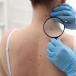 SkinVision sluit aan bij Zonvenant tegen huidkanker