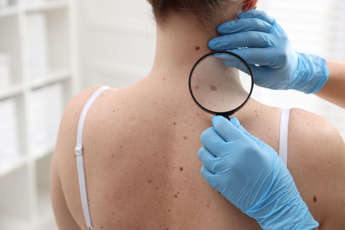 SkinVision sluit aan bij Zonvenant tegen huidkanker